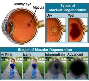 Showing perspective of an individual who is suffering from macular degeneration. over a period of time.
