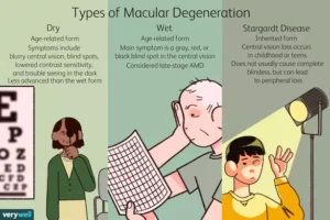 major types of macular degeneration as summarised in QUOVO article